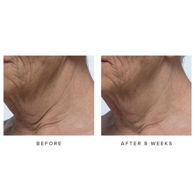 Before and after model shot of Ageless Revitalizing Neck Cream.